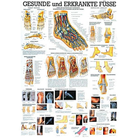 anat. Lehrtafel: Gesunde und erkrankte Füße 70 x 100 cm, laminiert Produktbild